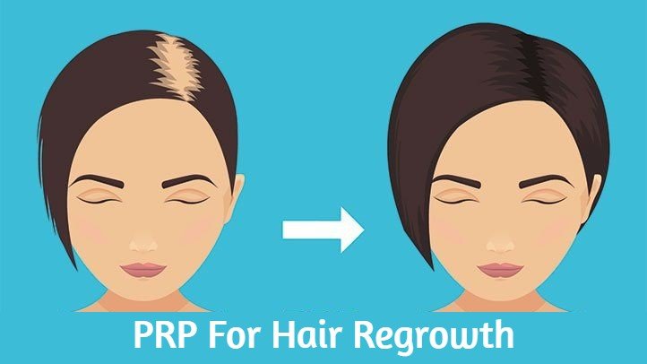 PRP For Hair Regrowth