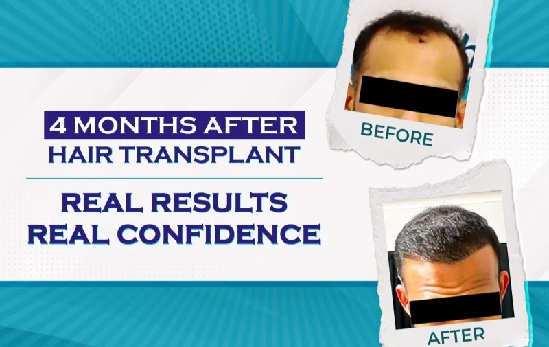 Best Hair Transplant Clinic In Bangalore