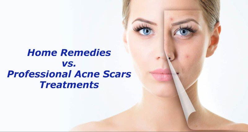 Professional Acne Scars Treatments