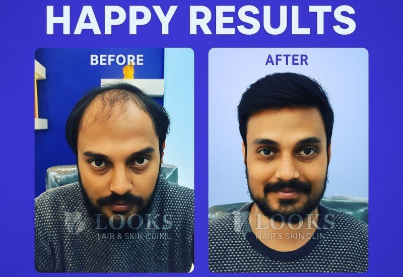 Best Hair Transplant Doctor in Bangalore