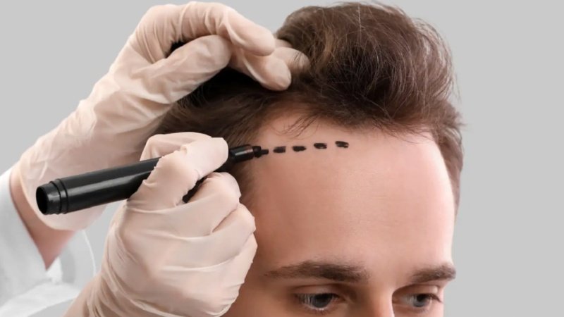 Best FUE Hair Transplant In Bangalore
